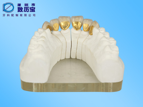 金碧烤瓷