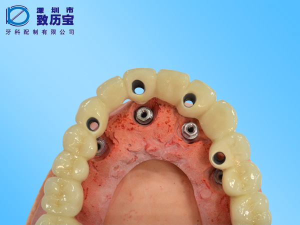 Dental implant