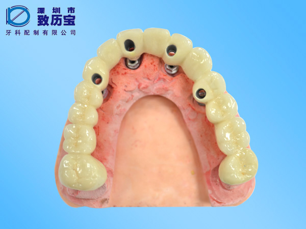 Dental implant