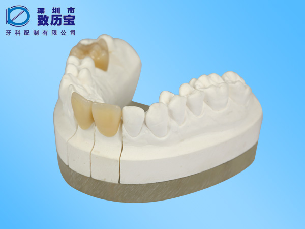 Porcelain teeth